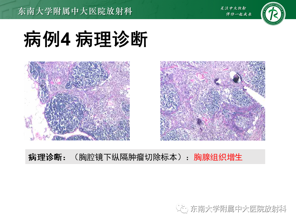 影像PPT - 【PPT】胸腺瘤-27 影像PPT - 【PPT】胸腺瘤-27