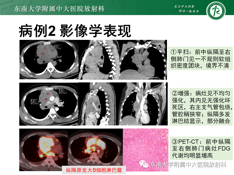 影像PPT - 【PPT】胸腺瘤-15 影像PPT - 【PPT】胸腺瘤-15