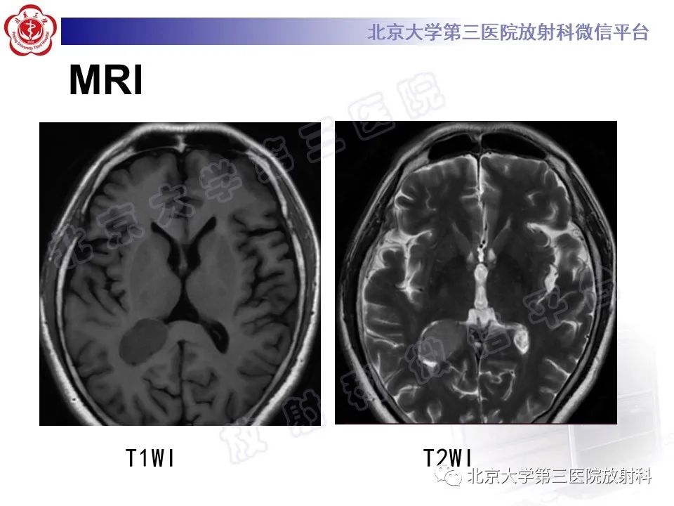 影像PPT - 【PPT】脑室内脑膜瘤-3