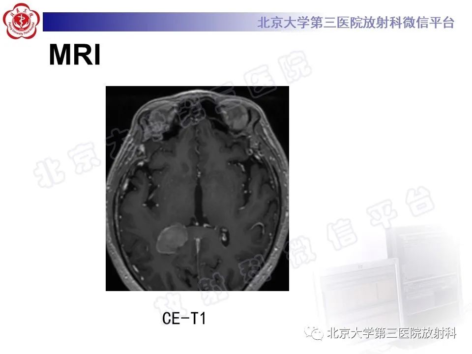 影像PPT - 【PPT】脑室内脑膜瘤-6