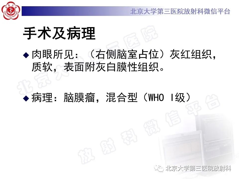 影像PPT - 【PPT】脑室内脑膜瘤-8