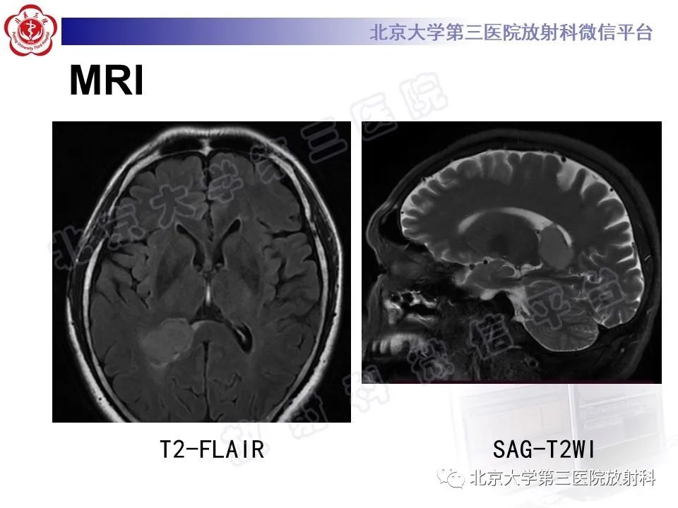 影像PPT - 【PPT】脑室内脑膜瘤-5