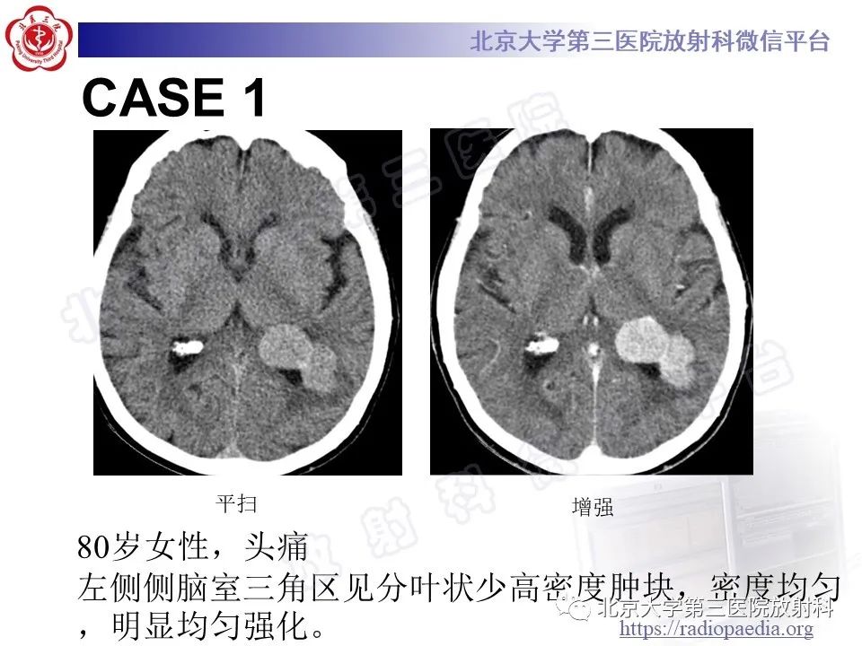 影像PPT - 【PPT】脑室内脑膜瘤-14