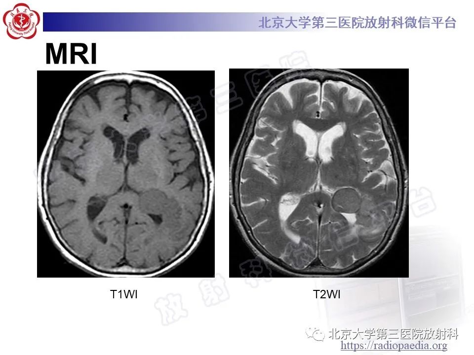 影像PPT - 【PPT】脑室内脑膜瘤-15