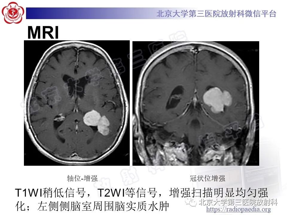 影像PPT - 【PPT】脑室内脑膜瘤-16