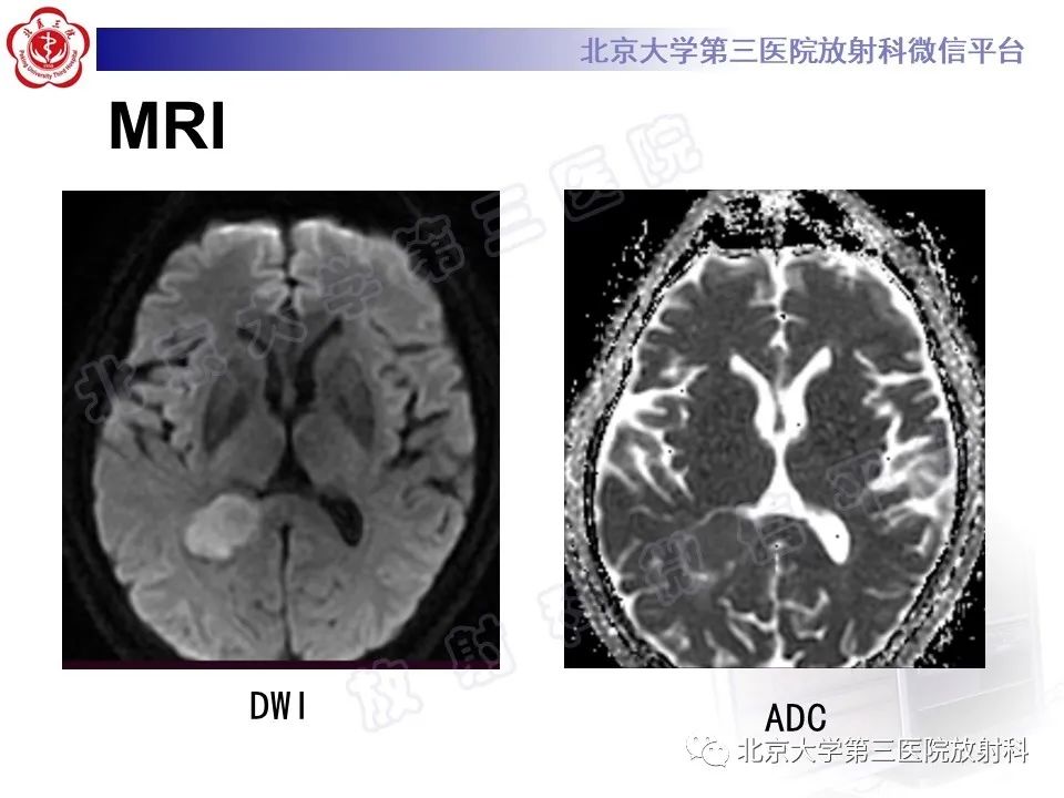 影像PPT - 【PPT】脑室内脑膜瘤-4
