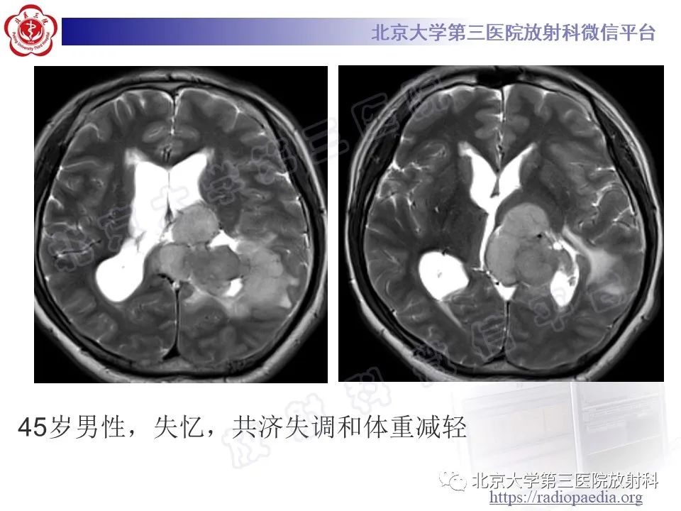 影像PPT - 【PPT】脑室内脑膜瘤-20