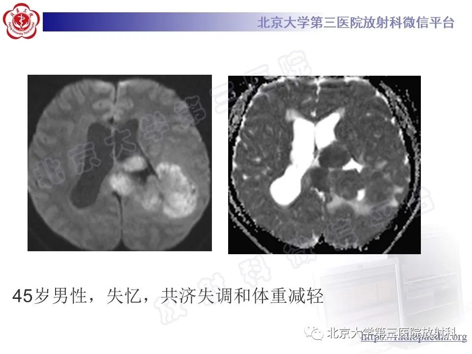 影像PPT - 【PPT】脑室内脑膜瘤-21