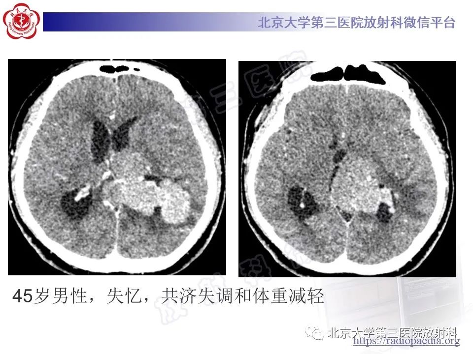 影像PPT - 【PPT】脑室内脑膜瘤-18