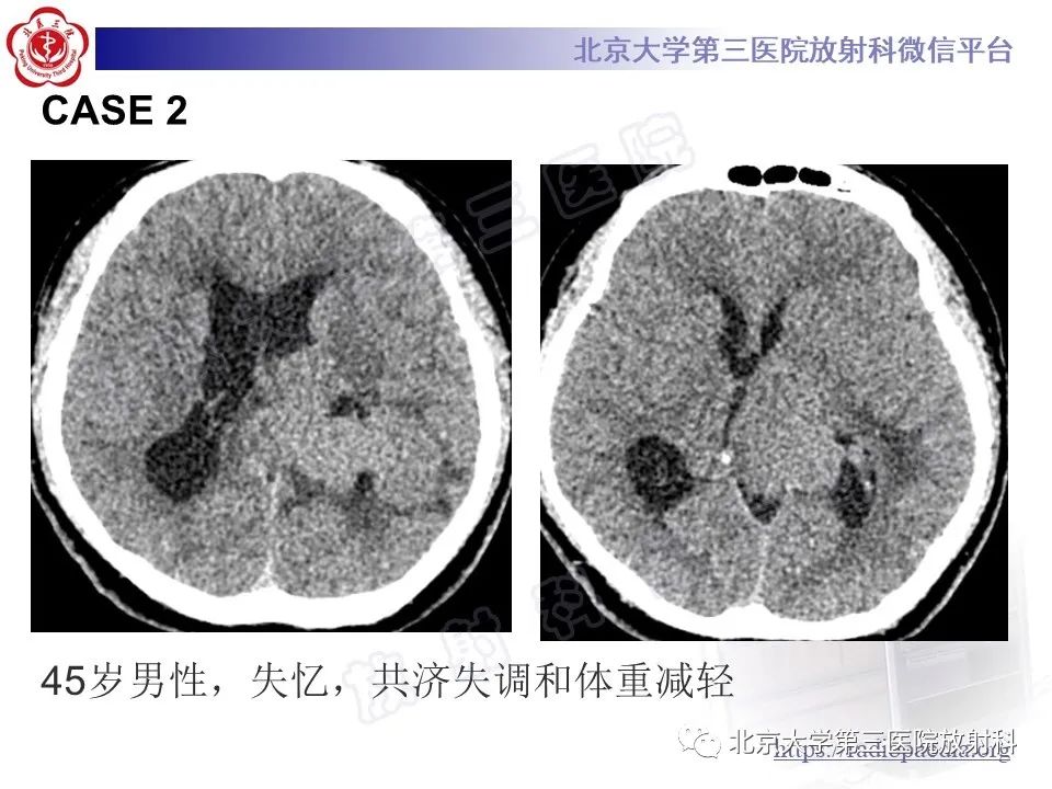 影像PPT - 【PPT】脑室内脑膜瘤-17