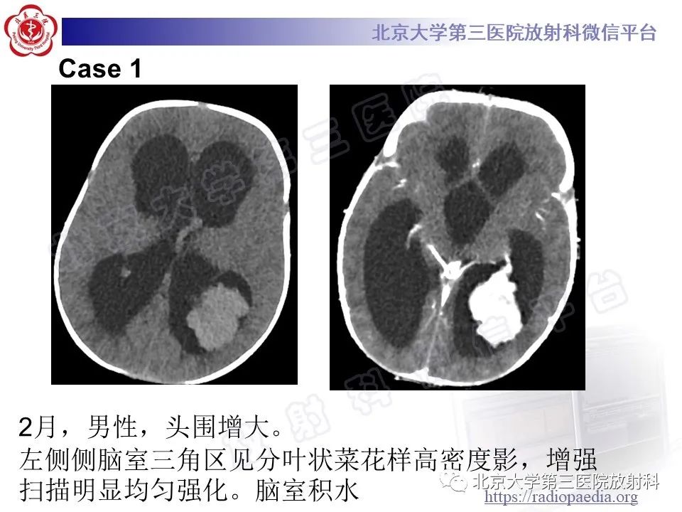 影像PPT - 【PPT】脑室内脑膜瘤-30