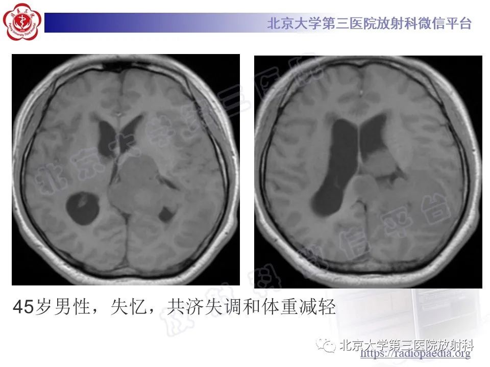影像PPT - 【PPT】脑室内脑膜瘤-19