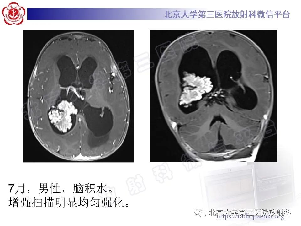 影像PPT - 【PPT】脑室内脑膜瘤-32