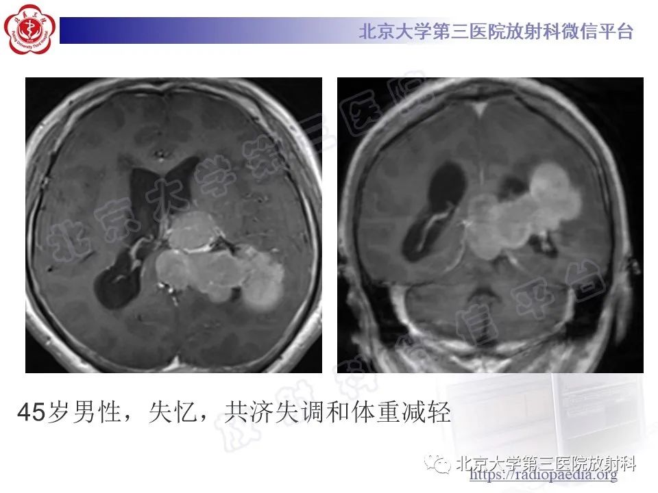 影像PPT - 【PPT】脑室内脑膜瘤-22