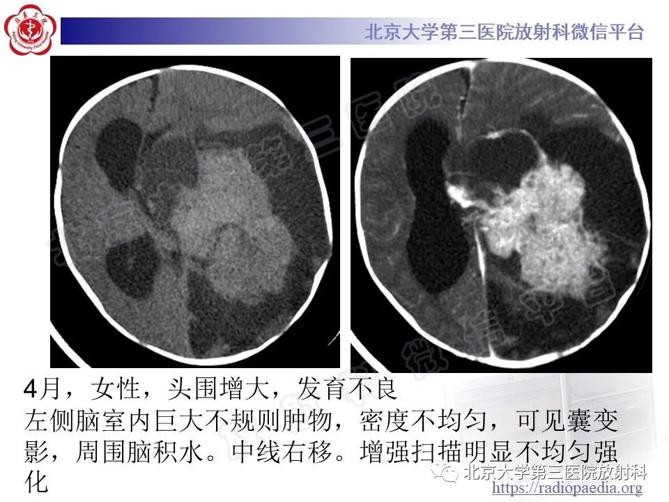 影像PPT - 【PPT】脑室内脑膜瘤-35