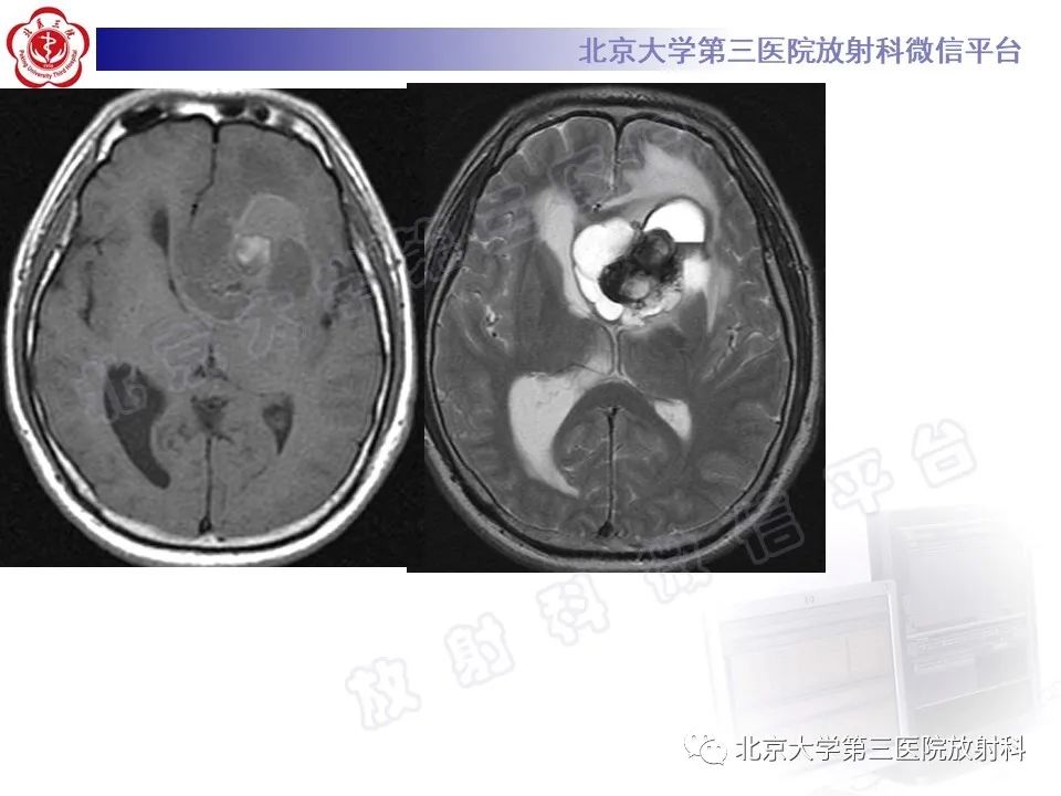 影像PPT - 【PPT】脑室内脑膜瘤-42