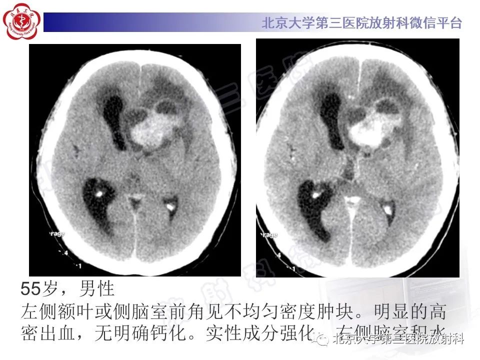 影像PPT - 【PPT】脑室内脑膜瘤-41