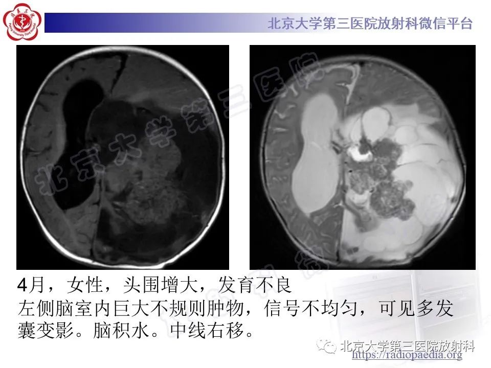 影像PPT - 【PPT】脑室内脑膜瘤-36