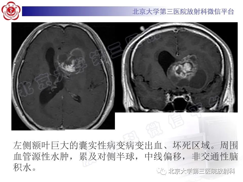 影像PPT - 【PPT】脑室内脑膜瘤-43