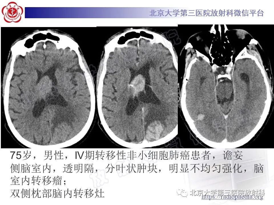 影像PPT - 【PPT】脑室内脑膜瘤-45
