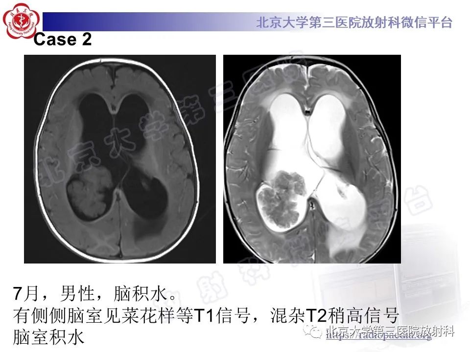 影像PPT - 【PPT】脑室内脑膜瘤-31