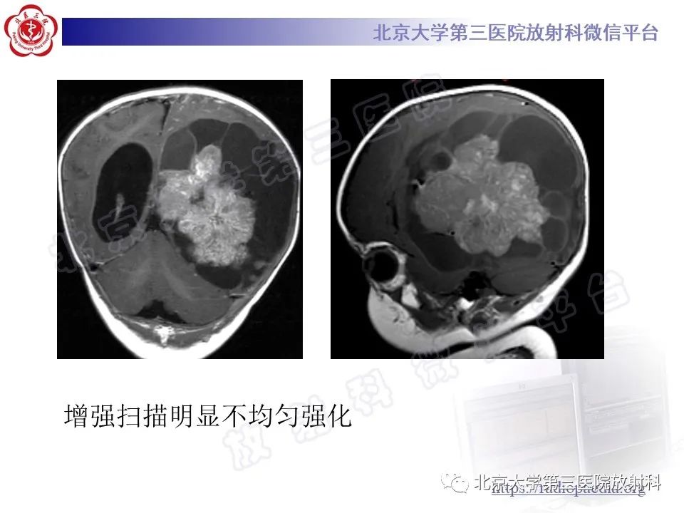 影像PPT - 【PPT】脑室内脑膜瘤-37