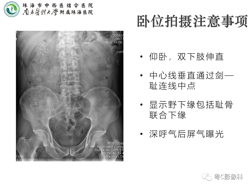 影像PPT - 【PPT】腹平片X线摄影及常见急腹症的诊断-7