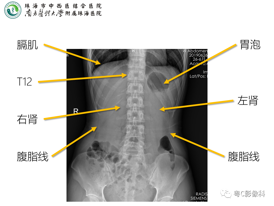 影像PPT - 【PPT】腹平片X线摄影及常见急腹症的诊断-5