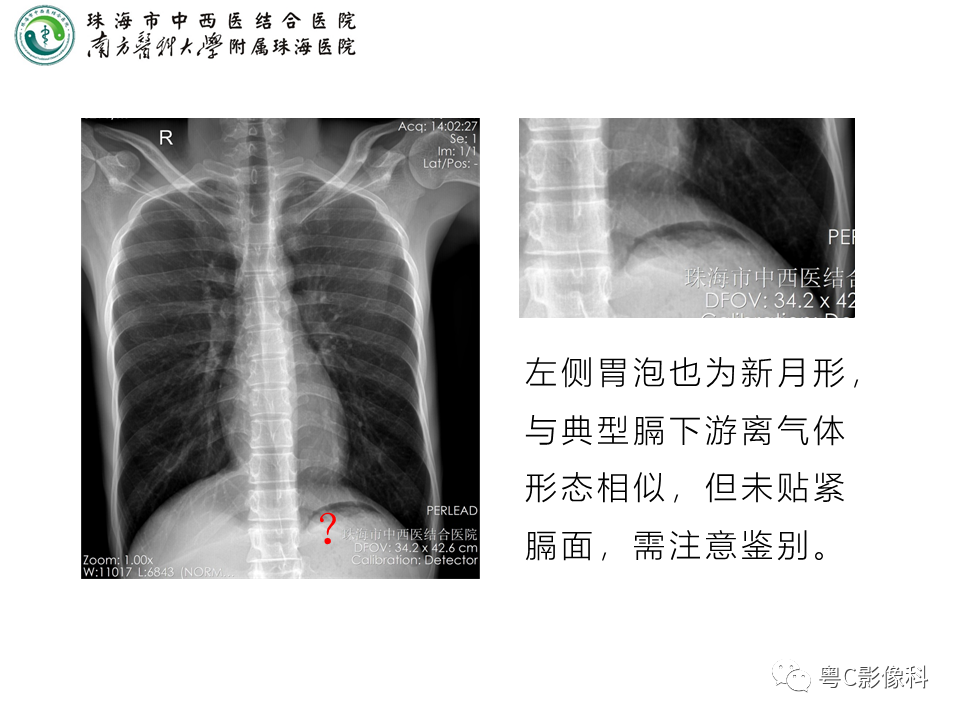 影像PPT - 【PPT】腹平片X线摄影及常见急腹症的诊断-15