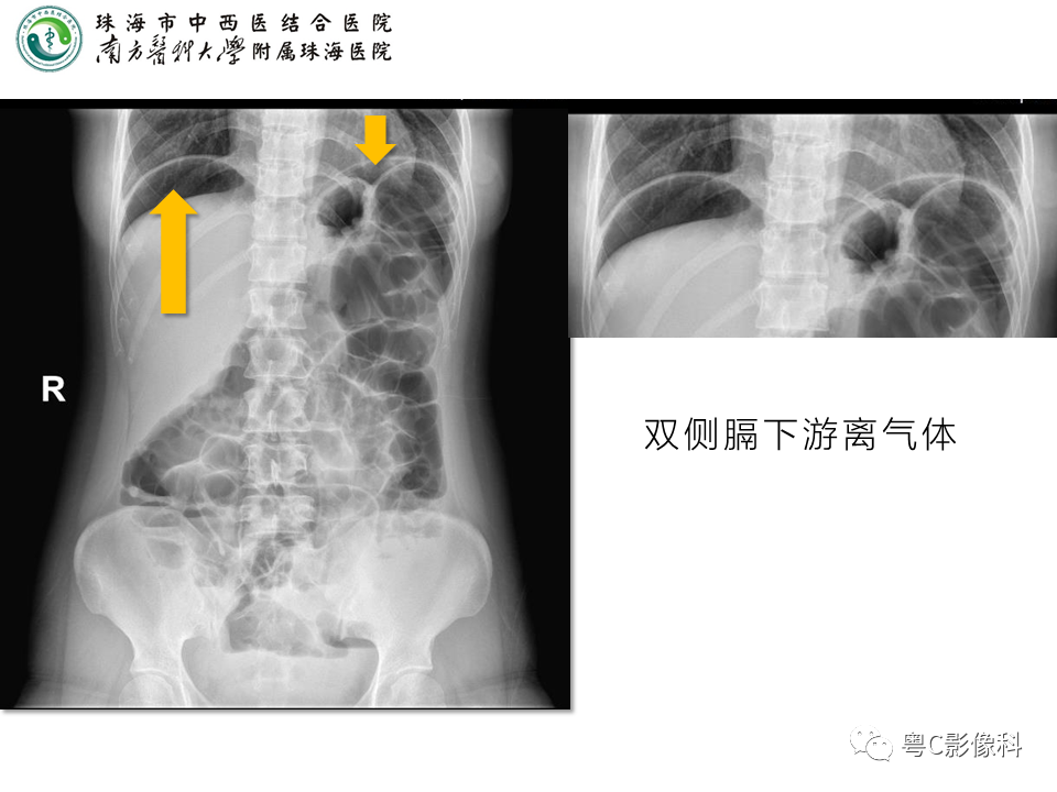 影像PPT - 【PPT】腹平片X线摄影及常见急腹症的诊断-17