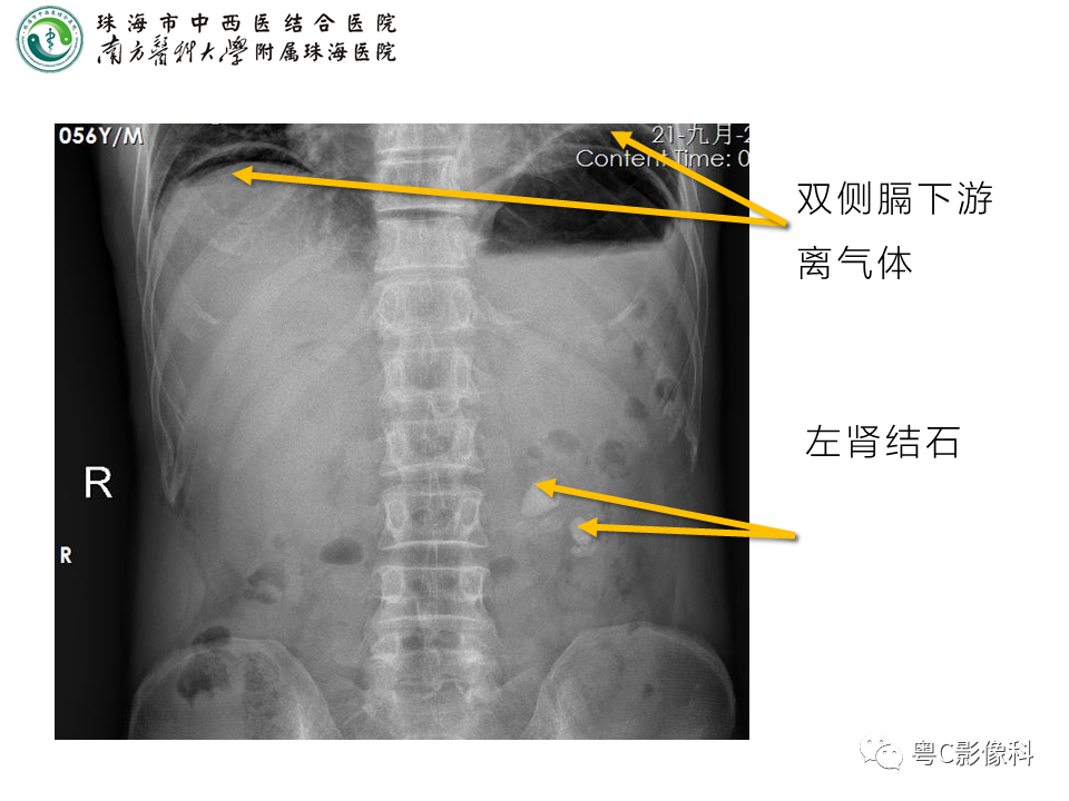 影像PPT - 【PPT】腹平片X线摄影及常见急腹症的诊断-16