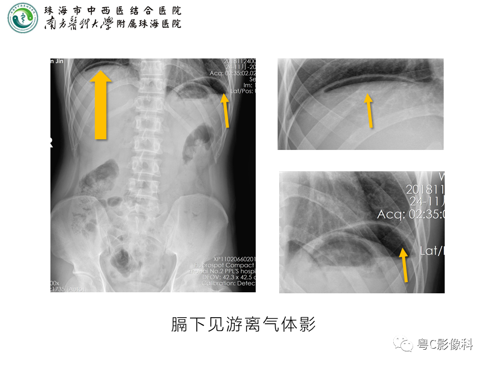 影像PPT - 【PPT】腹平片X线摄影及常见急腹症的诊断-14