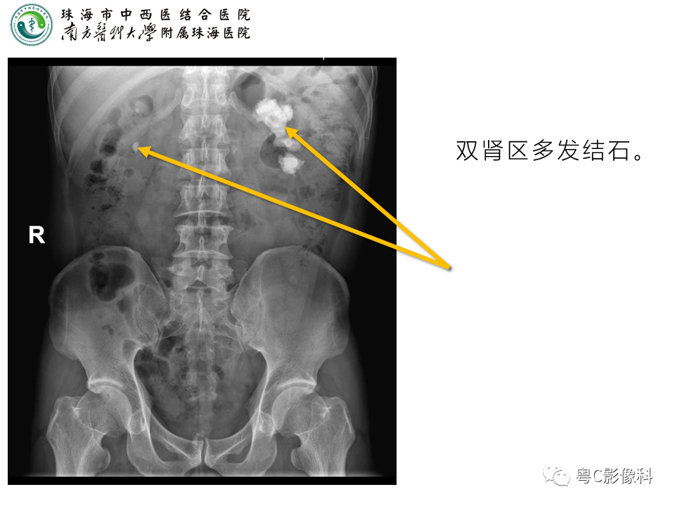 影像PPT - 【PPT】腹平片X线摄影及常见急腹症的诊断-21