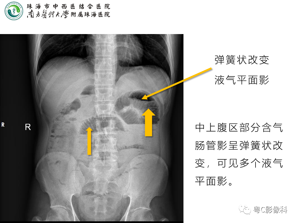影像PPT - 【PPT】腹平片X线摄影及常见急腹症的诊断-19