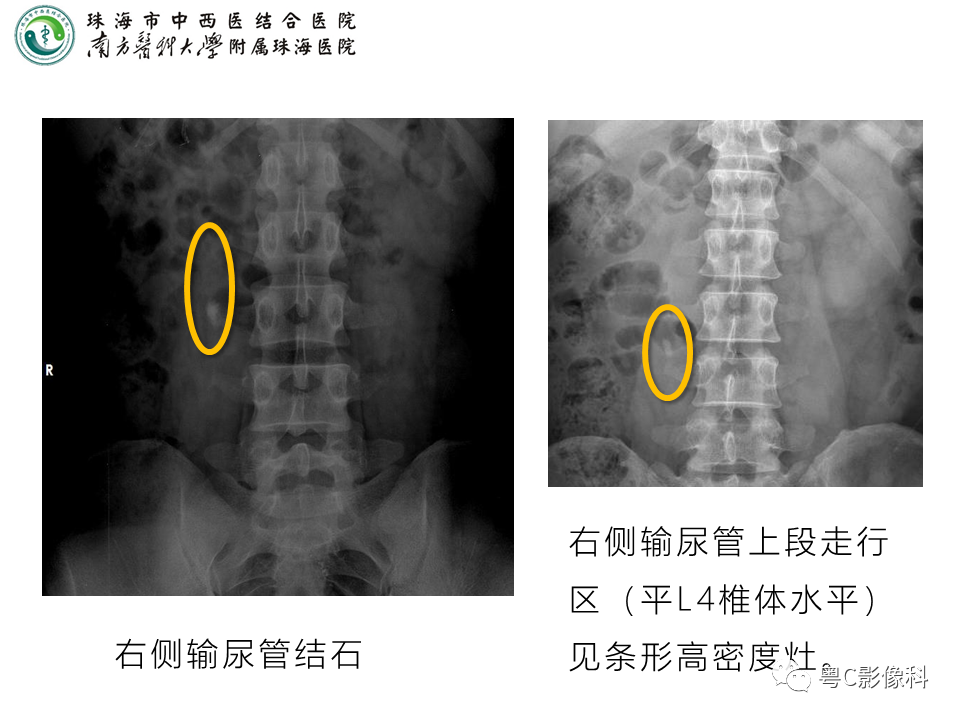 影像PPT - 【PPT】腹平片X线摄影及常见急腹症的诊断-22