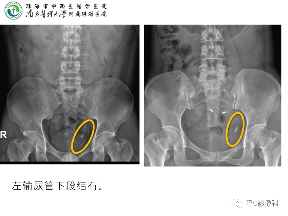 影像PPT - 【PPT】腹平片X线摄影及常见急腹症的诊断-23