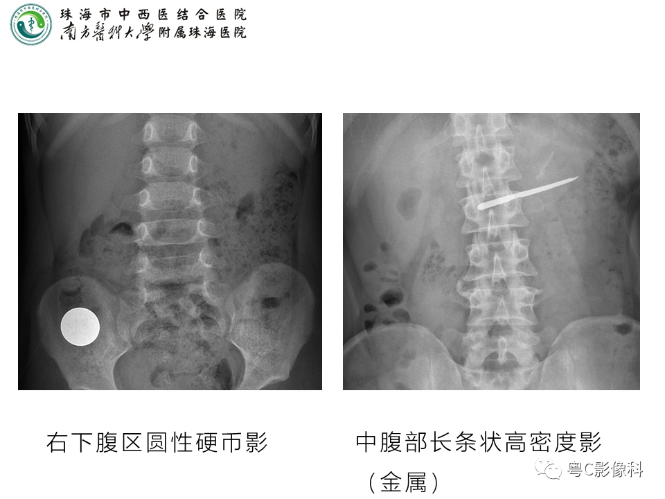 影像PPT - 【PPT】腹平片X线摄影及常见急腹症的诊断-26
