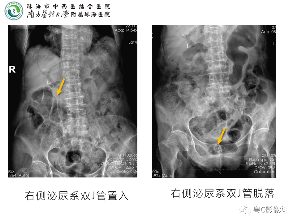 影像PPT - 【PPT】腹平片X线摄影及常见急腹症的诊断-28