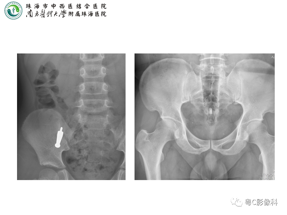影像PPT - 【PPT】腹平片X线摄影及常见急腹症的诊断-27