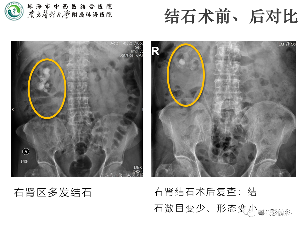 影像PPT - 【PPT】腹平片X线摄影及常见急腹症的诊断-24