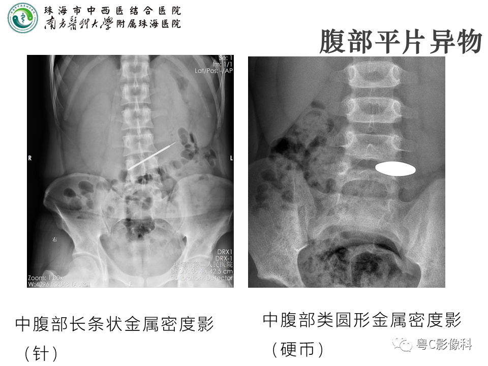 影像PPT - 【PPT】腹平片X线摄影及常见急腹症的诊断-25