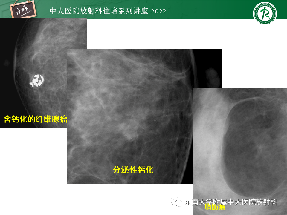 影像PPT - 【PPT】乳腺X线影像报告和数据系统（第五版）BI-RADS-5