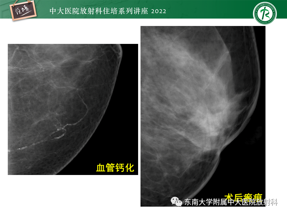影像PPT - 【PPT】乳腺X线影像报告和数据系统（第五版）BI-RADS-8