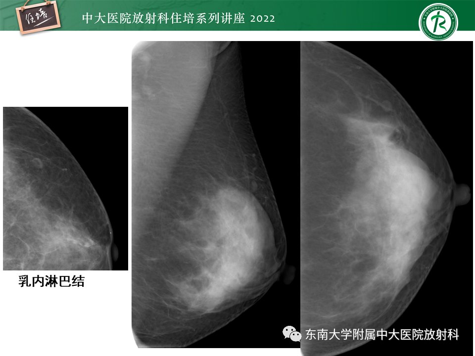 影像PPT - 【PPT】乳腺X线影像报告和数据系统（第五版）BI-RADS-7