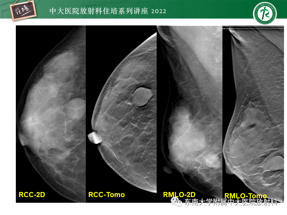 影像PPT - 【PPT】乳腺X线影像报告和数据系统（第五版）BI-RADS-12