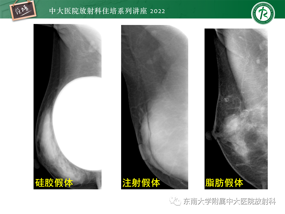 影像PPT - 【PPT】乳腺X线影像报告和数据系统（第五版）BI-RADS-9