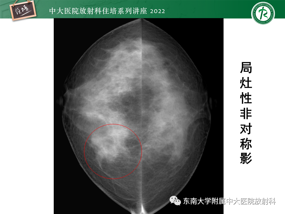 影像PPT - 【PPT】乳腺X线影像报告和数据系统（第五版）BI-RADS-14