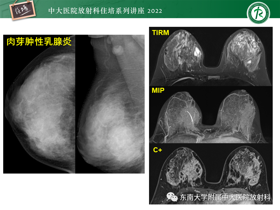 影像PPT - 【PPT】乳腺X线影像报告和数据系统（第五版）BI-RADS-24