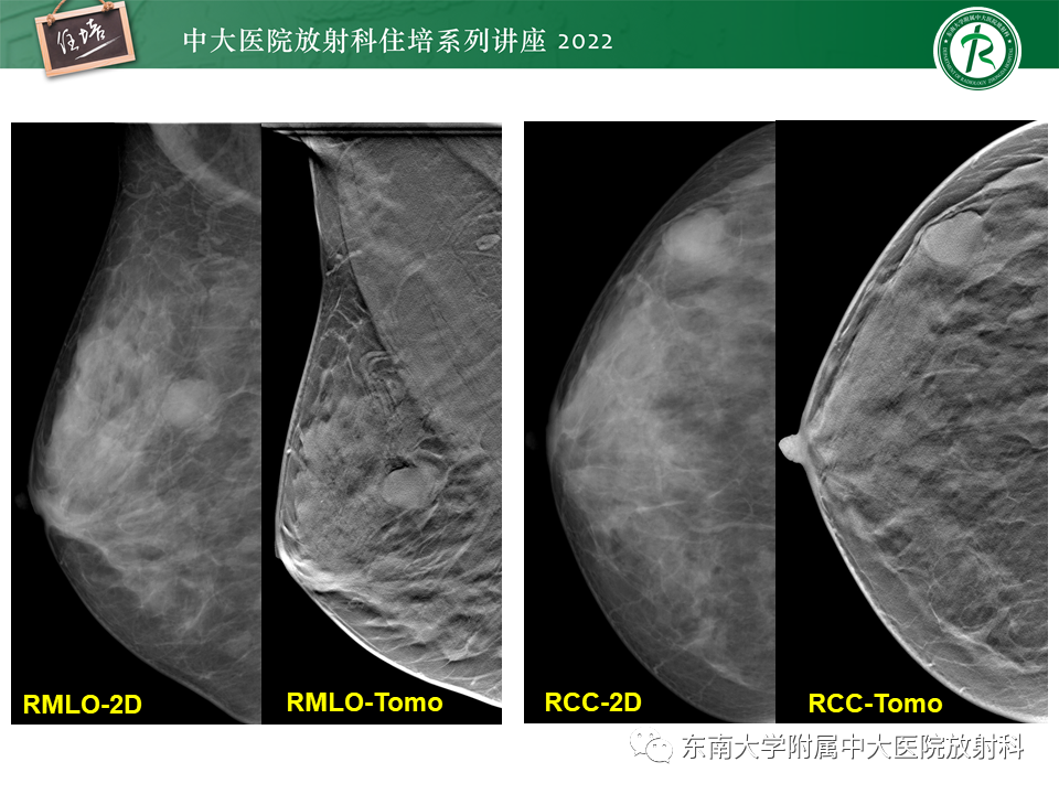 影像PPT - 【PPT】乳腺X线影像报告和数据系统（第五版）BI-RADS-19