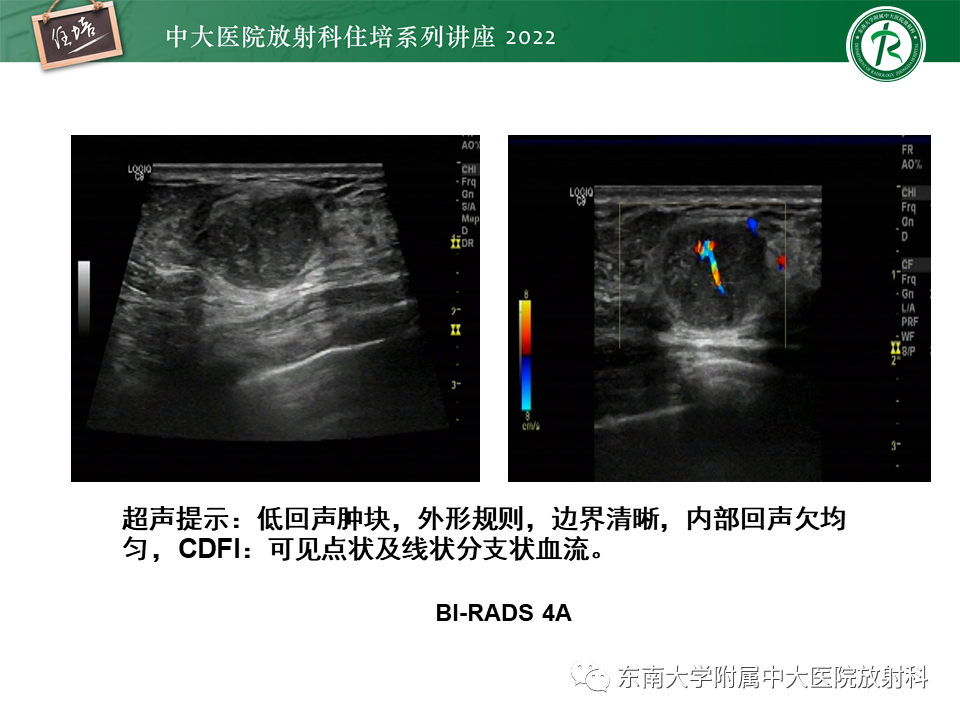 影像PPT - 【PPT】乳腺X线影像报告和数据系统（第五版）BI-RADS-20